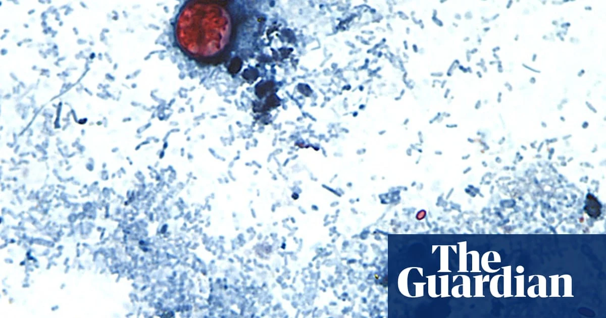 US Cyclosporiasis Outbreak Rises to 2,800 Cases