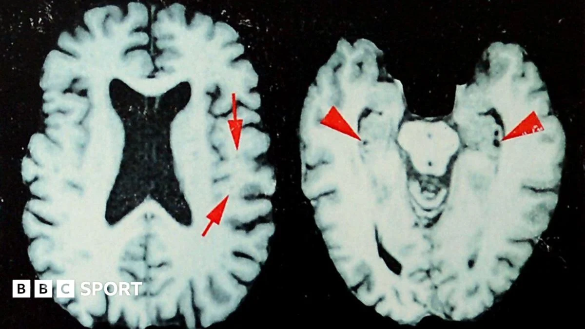 Brain Disease Found in Dead NFL Players Higher Than Thought