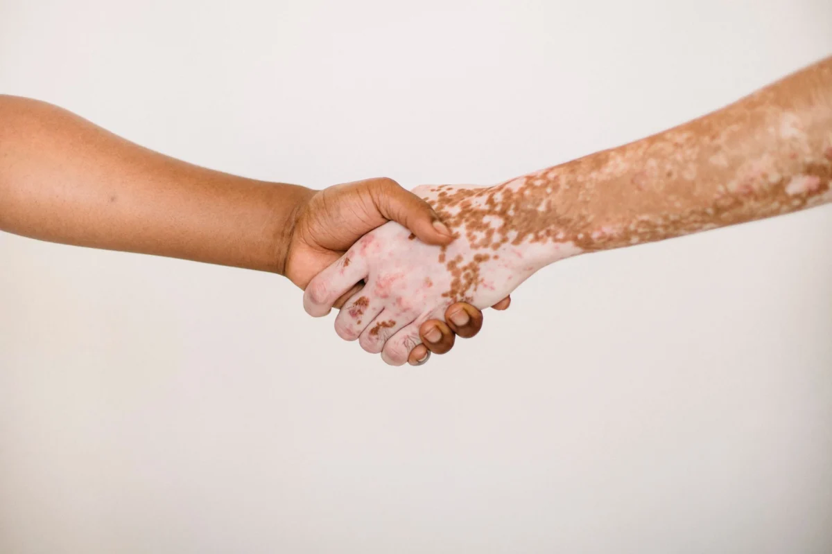China approves Johnson & Johnson psoriasis pill Icotyde