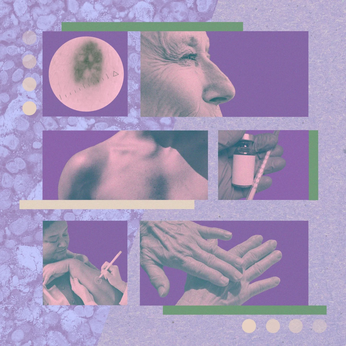 Melanoma Vaccine Offers New Hope in Cancer Treatment Expansion